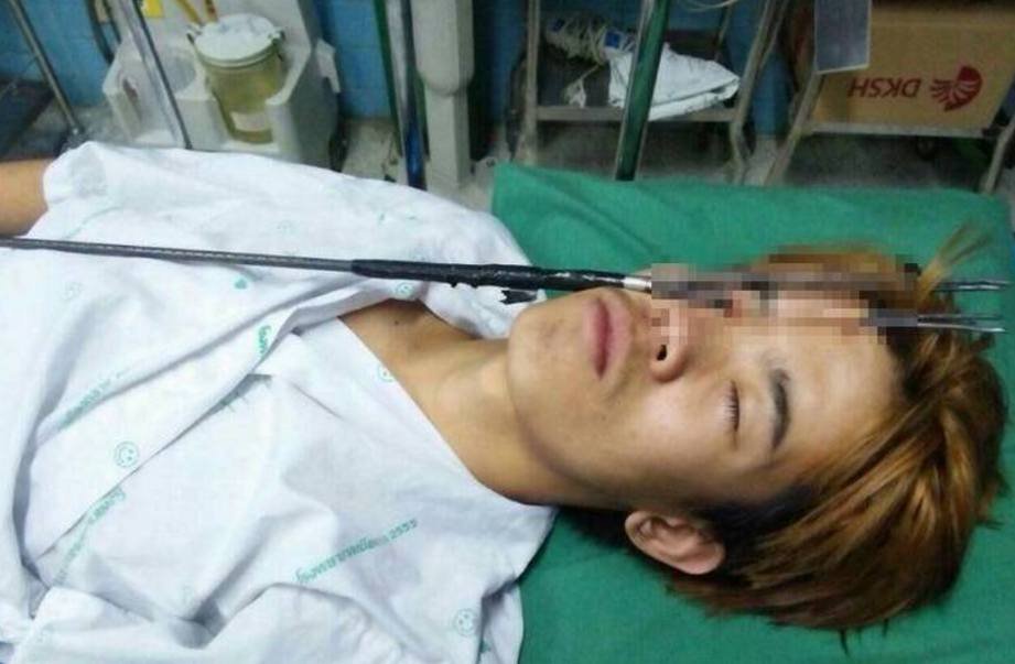 16-jähriger Thai sticht sich aus Versehen mit seiner Harpune ins Auge