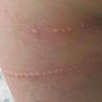 Man of War Quallen auch am Strand von Patong gesichtet