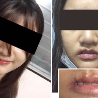 22-jährige wurde durch eine verpfuschte Schönheits-OP in Pattaya entstellt