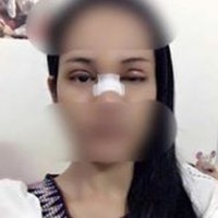 170.000 Baht von einem Touristen für eine Nasen Operation gestohlen