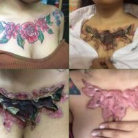 Studentin warnt mit schrecklichen Bildern vor dem Entfernen von Tattoos durch die „Rejuwi“ Technik