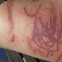 Warnung vor Quallen - Erste-Hilfe-Behandlung für Quallenstiche