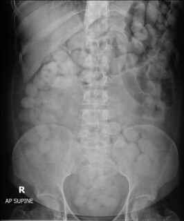 Ein Röntgenbild zeigt Kokainkügelchen im Körper eines Fluggastes.