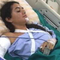 Einer britischen Reisenden wurde eine Krankenhausrechnung von ungefähr 40.000 £ präsentiert, nachdem sie nach einem Unfall in Thailand am Straßenrand liegen gelassen wurde. Ruby Spry, 20, fuhr Motorrad, als ein anderes Motorrad, das in die entgegengesetzte Richtung fuhr, in sie hineinfuhr, bevor sie losfuhr. Der Fahrer ließ Ruby bewusstlos und mit mehreren Verletzungen am Straßenrand liegen und flüchtete vom Unfallort.