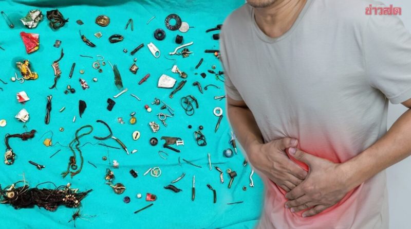 Ein Mann leidet seit über 2 Jahren unter Bauchschmerzen. Schließlich beschloss er, einen Arzt aufzusuchen, der feststellte, dass sich in seinem Magen viele Fremdkörper befanden. Bei den Gegenständen handelt es sich um gewöhnliche Gegenstände, die man in einem Haus finden würde, nicht in einen menschlichen Körper. Ein Mann leidet seit über 2 Jahren unter Bauchschmerzen. Schließlich beschloss er, einen Arzt aufzusuchen, der feststellte, dass sich in seinem Magen viele Fremdkörper befanden. Bei den Gegenständen handelt es sich um gewöhnliche Gegenstände, die man in einem Haus finden würde, nicht in einen menschlichen Körper.